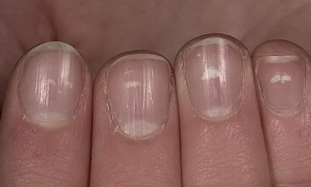 Se o fígado estiver doente ou comprometido, a unha terá três alterações anormais perceptíveis.